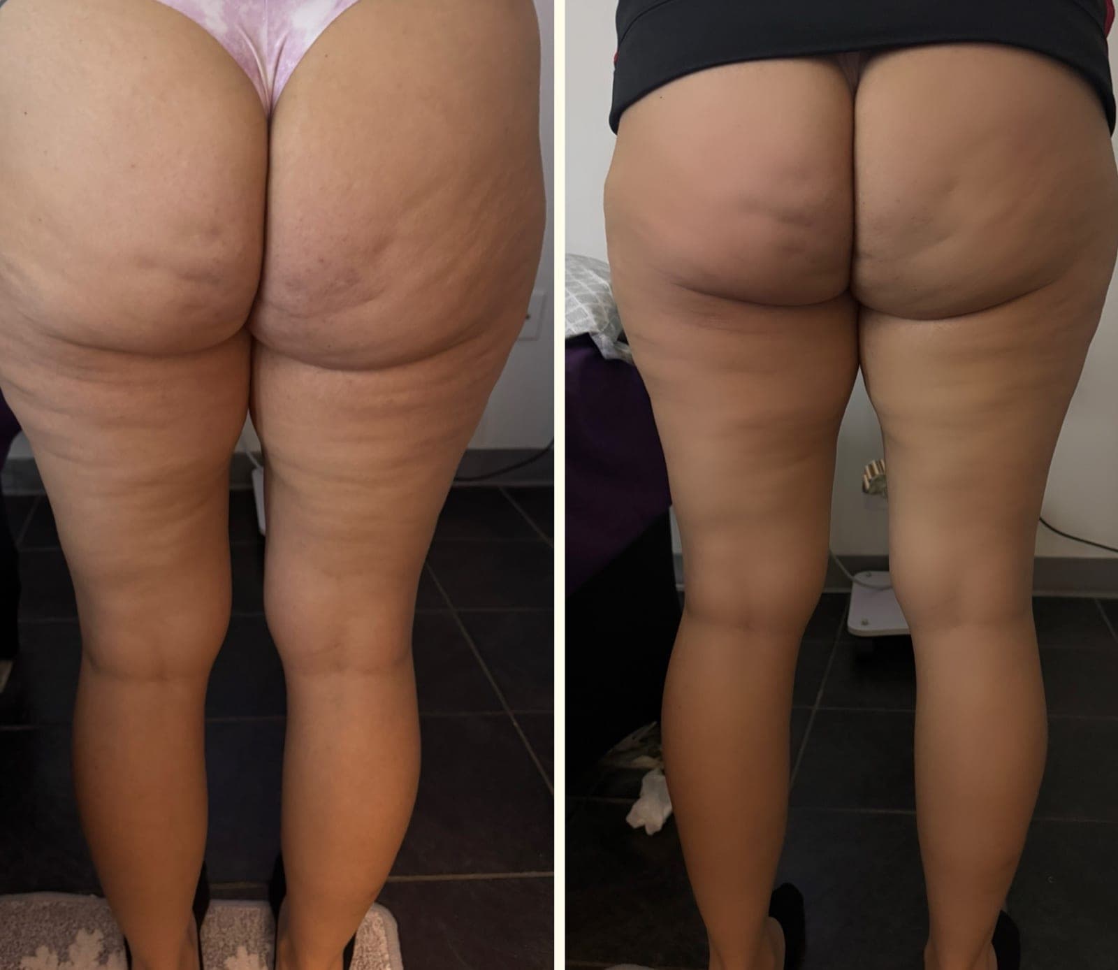 Real before and after result from a Bossa body sculpting treatment series.