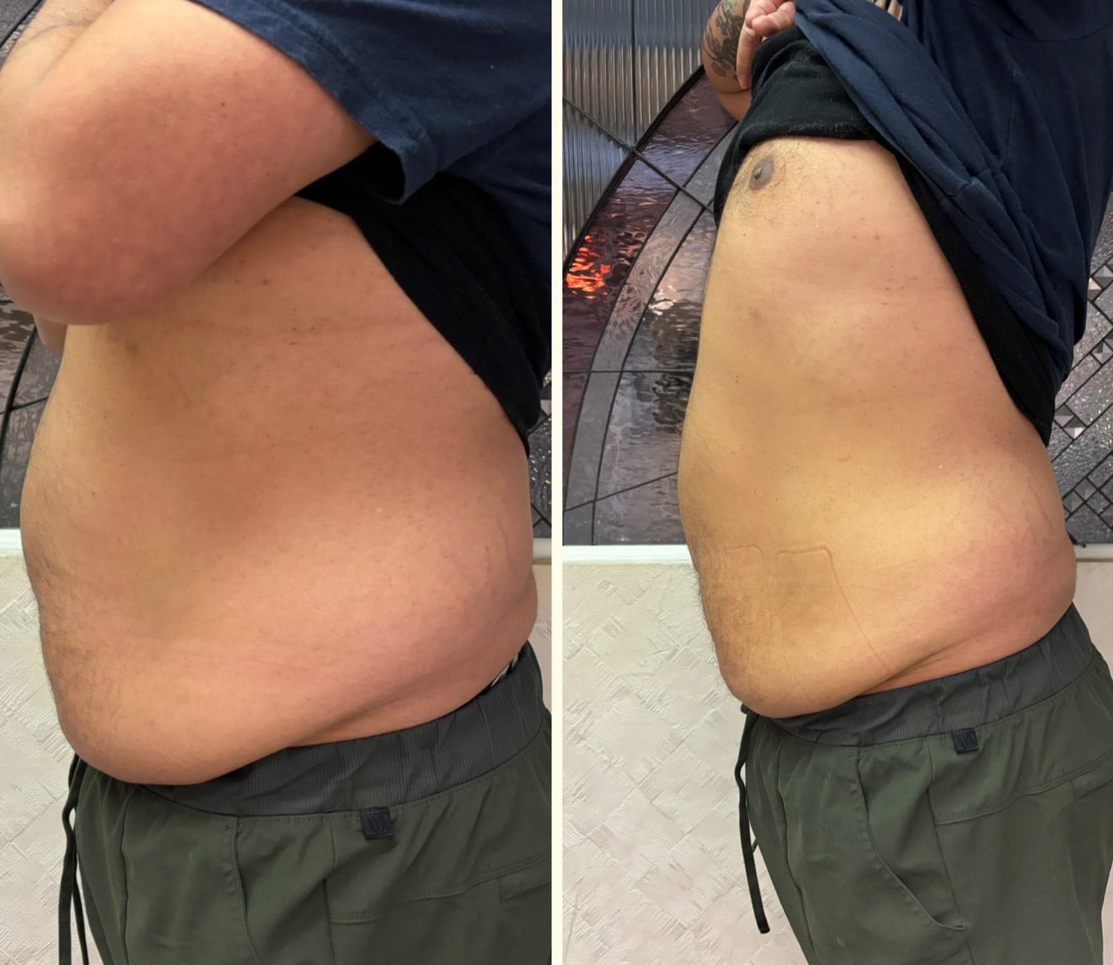 Real before and after result from a Bossa body sculpting treatment series.