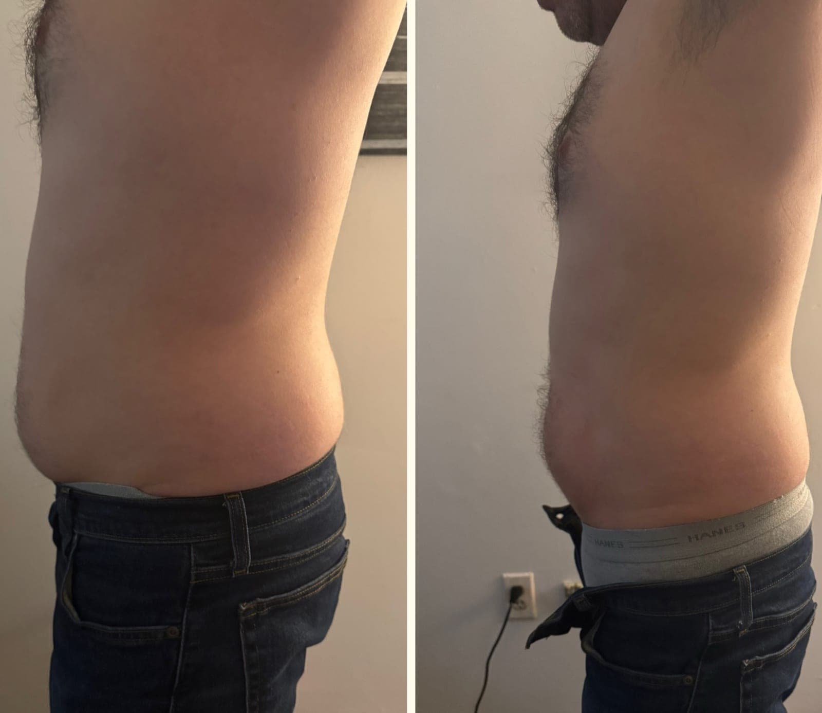 Real before and after result from a Bossa body sculpting treatment series.