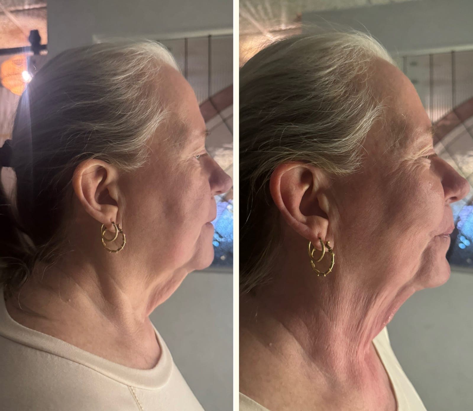 Real before and after result from a Bossa body sculpting treatment series.