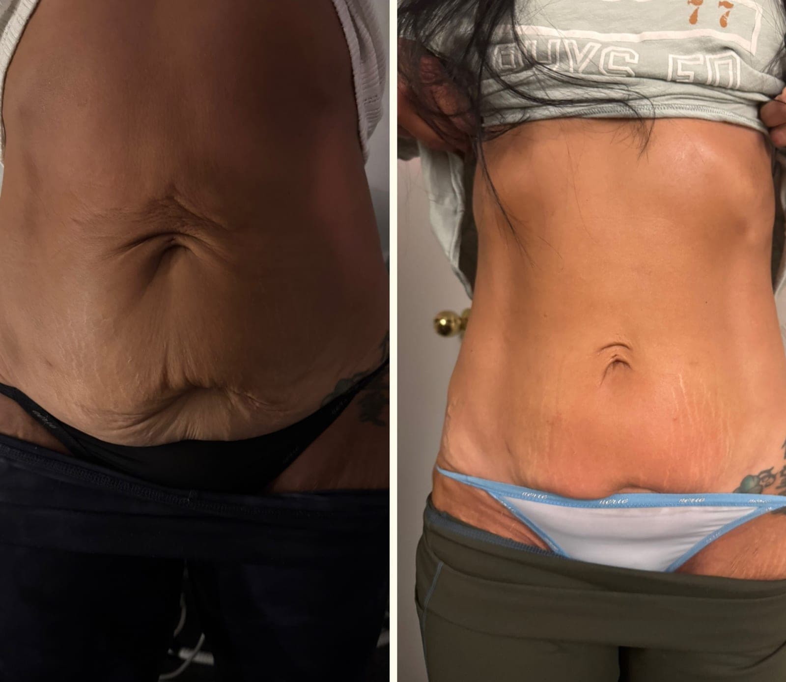 Real before and after result from a Bossa body sculpting treatment series.