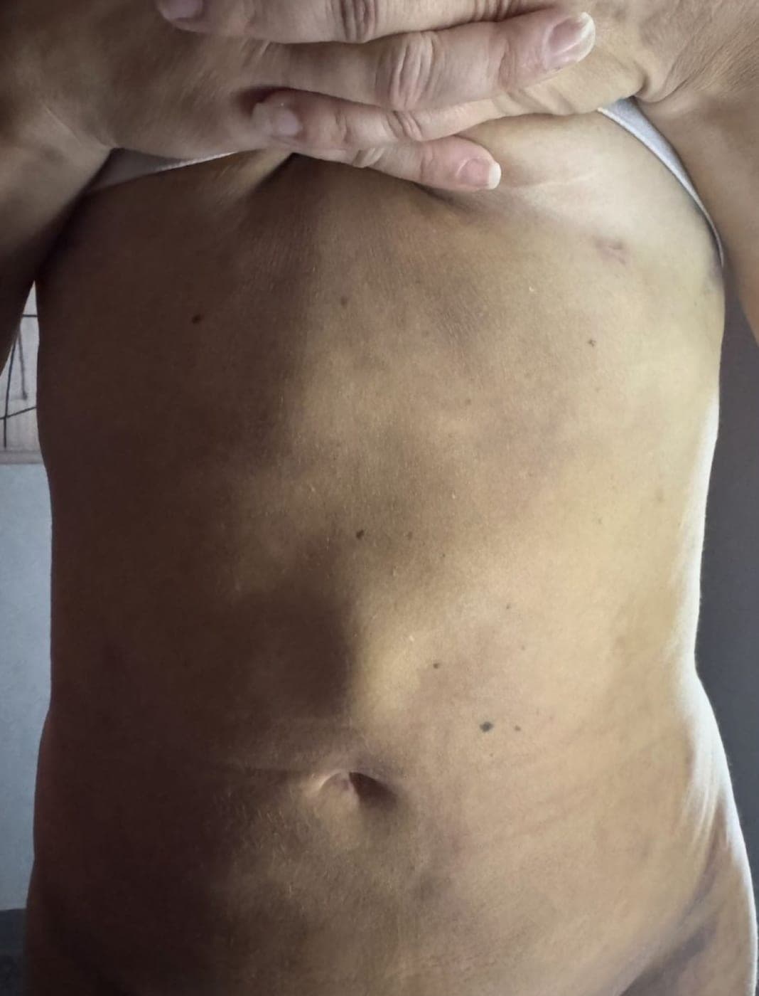 Collage of real Bossa body sculpting before and after results.