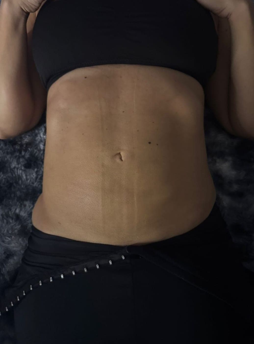 Collage of real Bossa body sculpting before and after results.